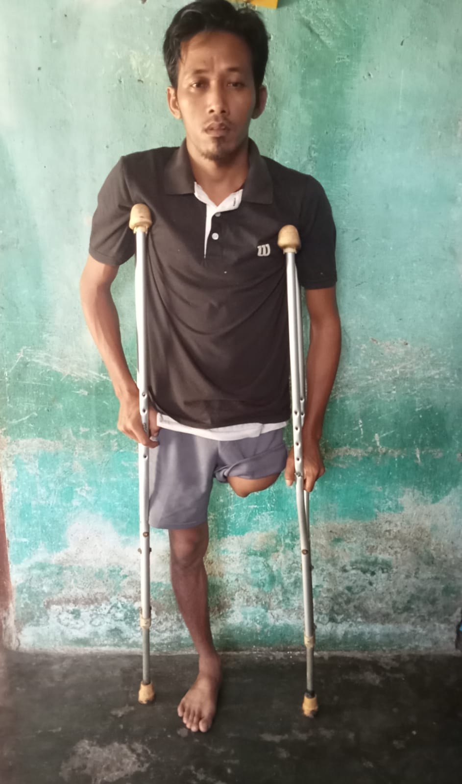 Butuh Kaki Palsu, Jeksan Berharap Bupati Seluma Dan Gubernur Bengkulu Bantu