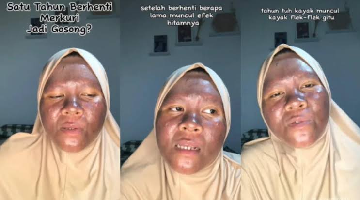 Larangan Menggunakan Pemutih Wajah Bagi Kaum Hawa! Harus Waspadai Ini, Percuma Cantik Kalau Terkena Ini