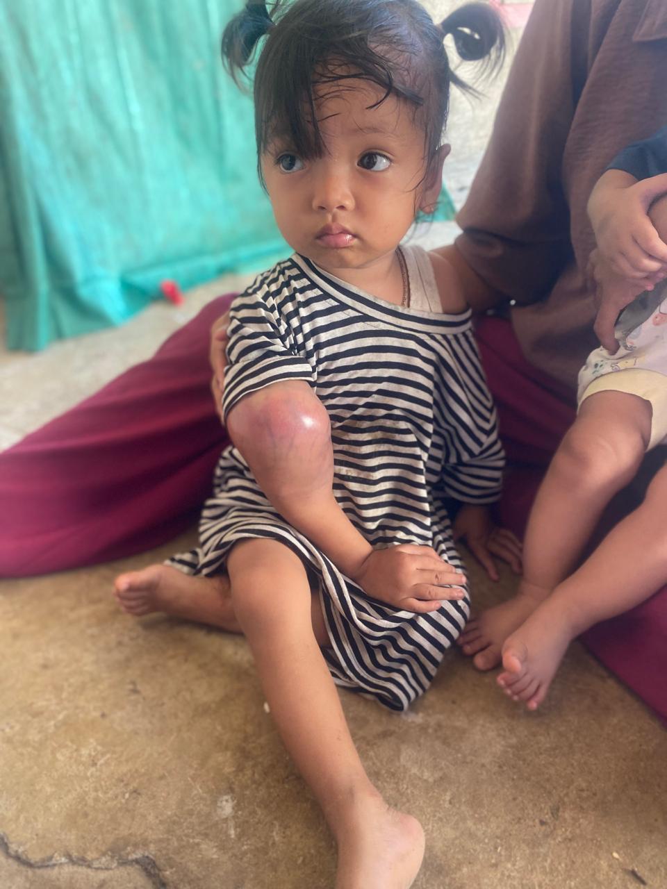 Bocah BS Umur 2 Tahun, Butuh Uluran Tangan Dermawan, Berjuang Melawan Penyakit Kangker