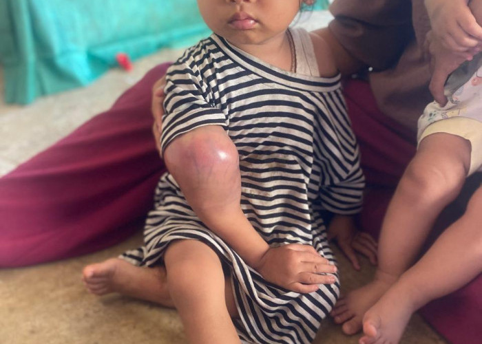 Bocah BS Umur 2 Tahun, Butuh Uluran Tangan Dermawan, Berjuang Melawan Penyakit Kangker